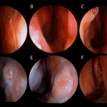 Endoscopic healing after free mucosal grafting during septal perforation repair