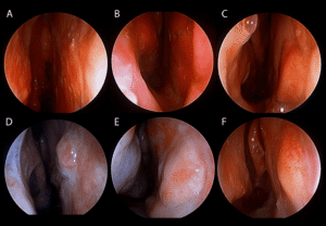 Endoscopic healing after free mucosal grafting during septal perforation repair